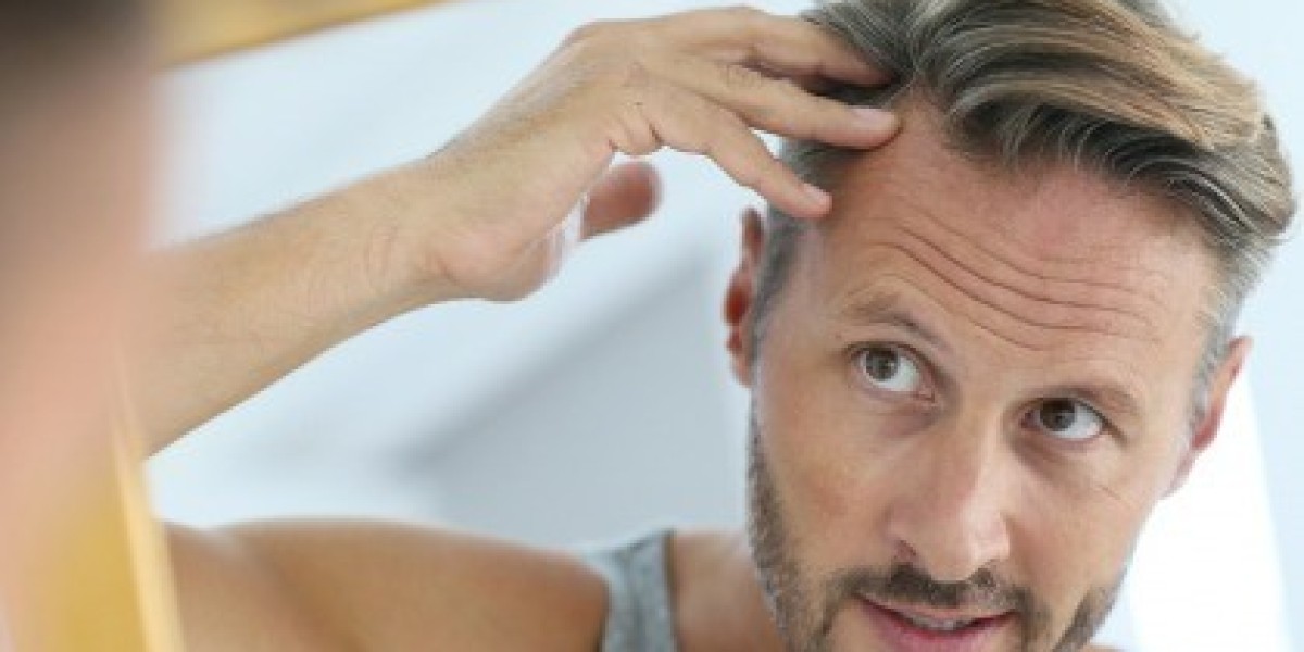 How Long Do Hair Transplants Last? 