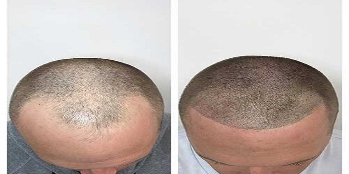 Locks Reimagined: Non-Surgical Paths to Overcoming Hair Thinning